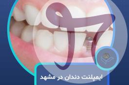 ایمپلنت دندان در مشهد  با اقساط بلندمدت و شرایط ویژه